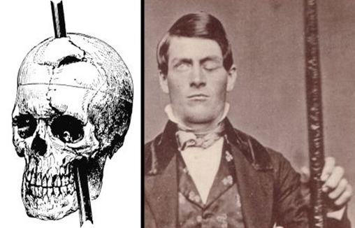 corteccia orbitofrontale phineas gage