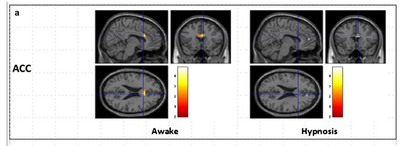 corteccia cingolata anteriore ipnosi fobia